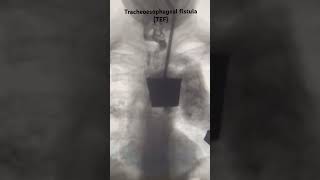 A tracheoesophageal fistula TEF radiology paediatric clinical neetpg [upl. by Etnahsal579]