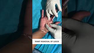 Warts Removal With Laser Treatment  Safe and Effective Wart Removal Treatment  Skinaa Clinicviral [upl. by Halilad]