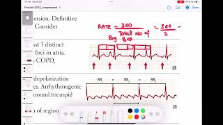 Multifocal atrial tachycardia cardiology 90  First Aid USMLE Step 1 in UrduHindi [upl. by Eugenio]