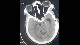 SDH  acuteonchronicsdh  ctscan craniotomy  urgent burr hole or craniotomy [upl. by Asinla]