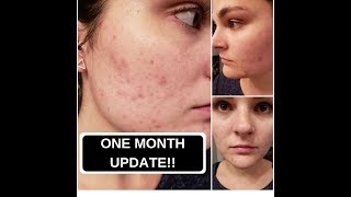 Spironolactone for Acne 1 MONTH UPDATE  Episode 2 [upl. by Huntingdon]