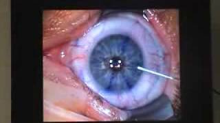 Opération lasik des yeux pour corriger les défauts visuels [upl. by Nahtannhoj]