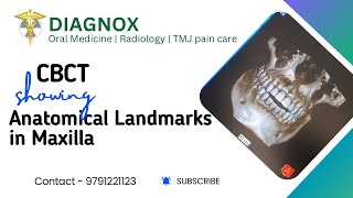 CBCT showing Anatomical Landmarks in Maxilla CBCTimaging [upl. by Talia]