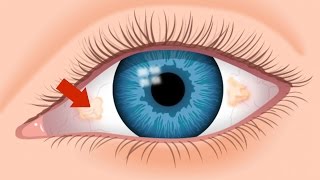 What Are The Ugly Yellow Spots In My Eye  An Optometrist Explains  True Eye Experts [upl. by Abert]