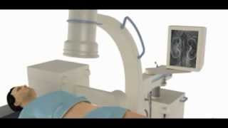 Lithotripsy for kidney stone treatment [upl. by Lanevuj]