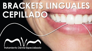 CEPÍLLATE LOS DIENTES CON BRACKETS LINGUALES ¡ APRENDE YA  Cepillado con Ortodoncia Invisible [upl. by Carry]