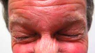 What is Blepharospasm Symptoms Causes Treatment [upl. by Yedok519]