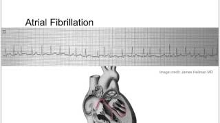 Tachycardia Basic Discussion [upl. by Assirolc]