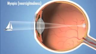 Four Main Types of Refractive Error vision problems  Eye Associates [upl. by Namyh]