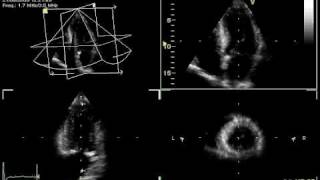 3D ECHO LVEF VOLUME [upl. by Neeven]