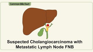 Suspected cholangiocarcinoma with Metastatic Porta Hepatis Lymph Nodes [upl. by Marlee]