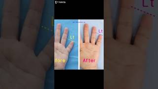 brachydactyly brachydactylytypeD 短指症手術 短指症 大拇指短粗 マムシ指 しゃもじ指 まむし指 우렁손톱 단지증 단지증수술 단지증수술후기 [upl. by Farro]