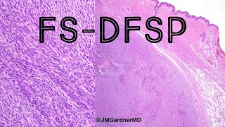 FSDFSP fibrosarcomatous dermatofibrosarcoma protuberans pathology dermpath dermatology [upl. by Zanahs]