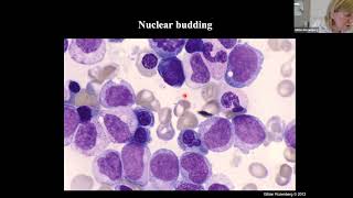 WHO Classification of Myelodysplastic Syndromes [upl. by Dafodil]