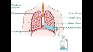 drainage pleural [upl. by Louie]