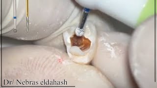 access cavity preparation for badly decayed maxillary Premolar upper 4 [upl. by Azilanna]