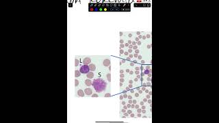 Chronic Leukemia for USMLE STEP 1 [upl. by Enrichetta]