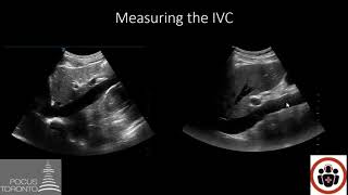 POCUS Cases 4 IVC POCUS for volume status [upl. by Annel]