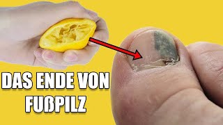 Dieses Hausmittel entfernt lästigen Fuß und Nagelpilz [upl. by Ramsdell]