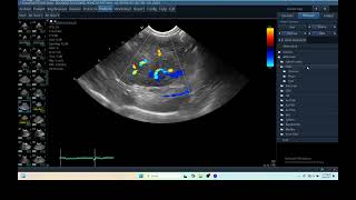 IQ 279 LIVER ULTRASOUND HEPATOMA ECHOPAC ANALYSIS ECHOCARDIOGRAPHY COLOR FLOW MAPING [upl. by Laynad]