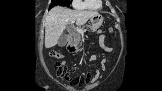 Choledocholithiasis  CT findings [upl. by Anahsak]