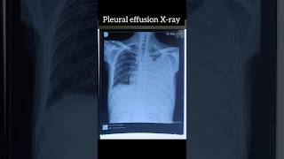 Chest Xray of Pleural Effusion [upl. by Allehs16]