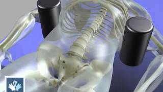 Sciatica  Spinal Decompression  Back Clinics of Canada [upl. by Yeclehc]