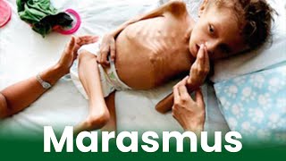 मरास्मस रोग किसकी कमी के कारण होता है Marasmus Disease Symptoms Causes amp Prevention amp Treatment [upl. by Harriet]