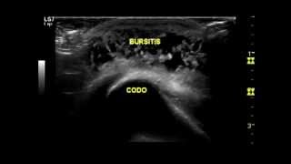 Ecografía en Bursitis de codo [upl. by Chew]