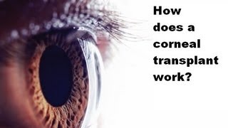 How is a corneal transplant done [upl. by Phaedra]