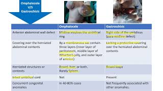 Omphalocele vs Gastroschisis  Spot Diagnosis  6  Pediatrics [upl. by Anthea544]