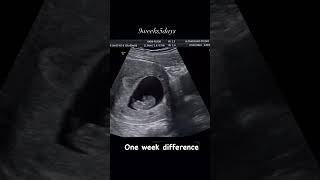 9 week baby movement in womb pregnancy ultrasound pregnancycare [upl. by Ahseihs]