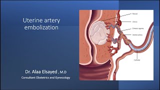 Uterine Artery Embolization UAE [upl. by Aysab]