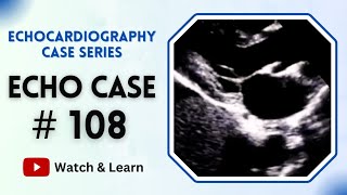 ECHO CASE 108  Echocardiography For Beginners [upl. by Andrews]