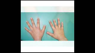 Brachydactyly Treatment  Symptoms and Causes  Diagnosis  Prevention health [upl. by Engleman]