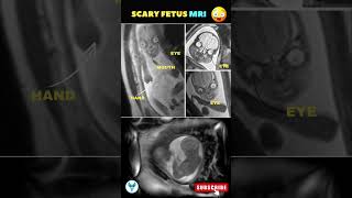 Baby MRI  Fetal scan  Pregnancy week by week pregnancy mri sonography [upl. by Ardnahc]