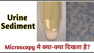 urine sediment examination  urine sediment microscopy  urine sediment [upl. by Horowitz123]