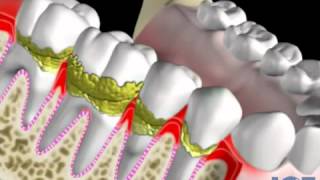 Sarro problemas periodontales pérdida osea y movilidad Dental Advance [upl. by Arlena]