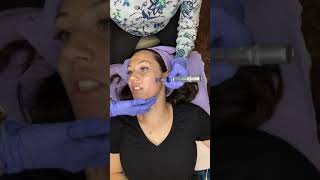 Microneedling Procedure amp Tutorial [upl. by Ssidnac]