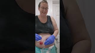 ileostomy output during appliance change and tips hollister ostomy output stoma support [upl. by Anaek]