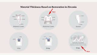 Zirconia 101 3 of 11 Preparation Indications for zirconia [upl. by Erny]