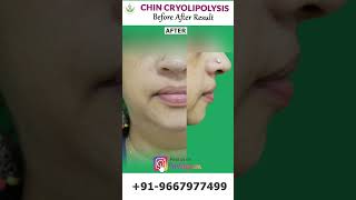 Chin Transformation with Cryolipolysis Before and After Results  Care Well Medical Centre shorts [upl. by Naejarual44]