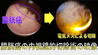 膀胱癌の実際の内視鏡切除術の動画です。解説つきの動画です。 [upl. by Yrdua]