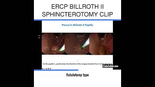 ERCP Billroth II Sphincterotomy Clip [upl. by Kemble]