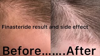 Finasteride resultFinasteride Aide effectFinasteride use Karna chahiye ya nahi [upl. by Enileoj]