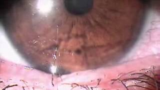 Trichiasis forceps and epilation [upl. by Luy274]