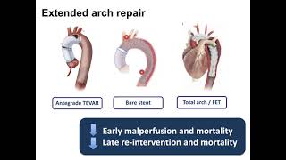 Approach to the Arch in Acute Type A Aortic Dissection [upl. by Renfred]