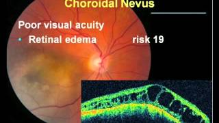 Long Term Followup of a Choroidal Nevi [upl. by Genevra]