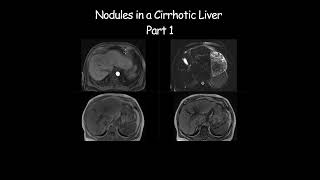 Nodules in a Cirrhotic Liver  Part 1 radiology radiologist cirrhosis liverdisease liverhealth [upl. by Ledeen422]