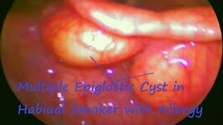 Laryngology  Multiple Epiglottic Cyst in Habiual Smoker with Allergy [upl. by Gregoor776]